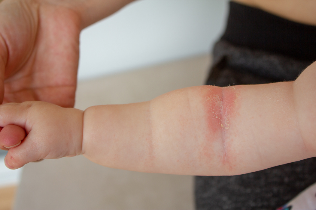 Un bebe con una condicion de piel en su brazo.