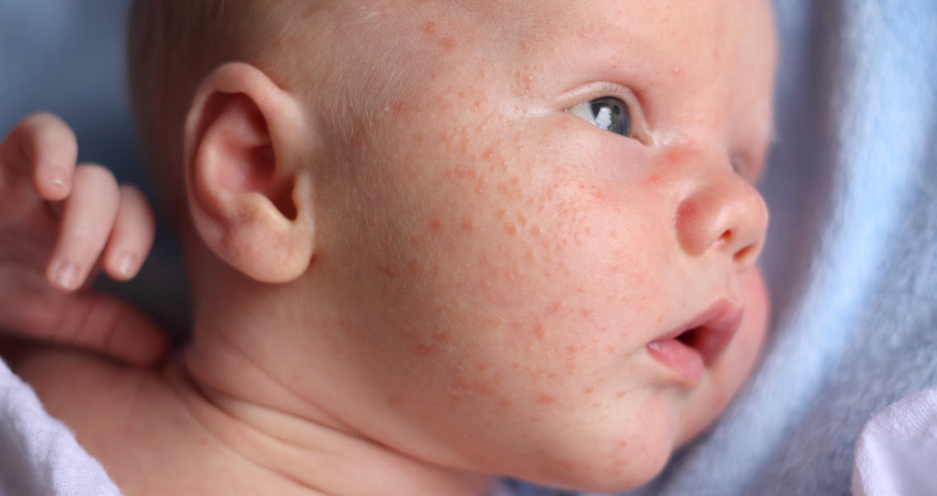 baby with acne on face