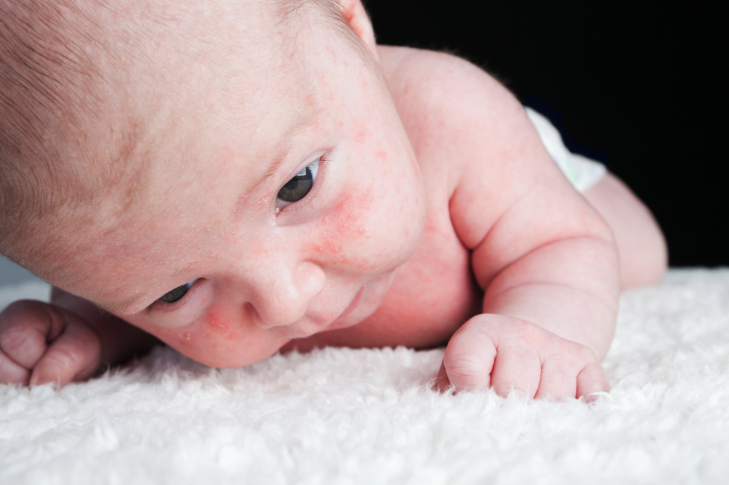 Un bebe gateando con una condicion de piel en su cara.