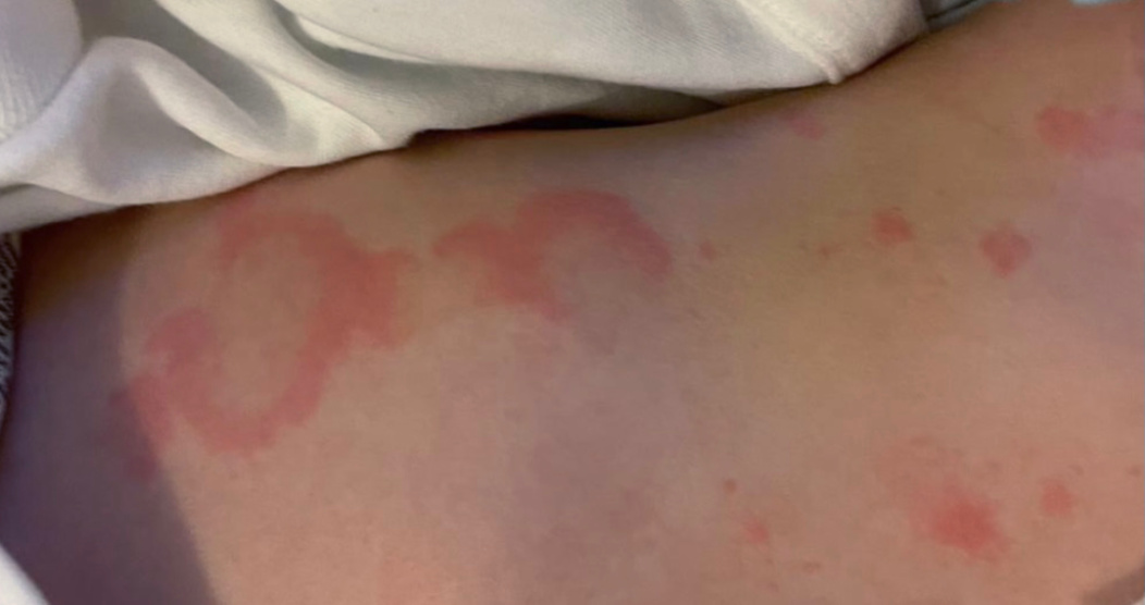 baby dry skin rash