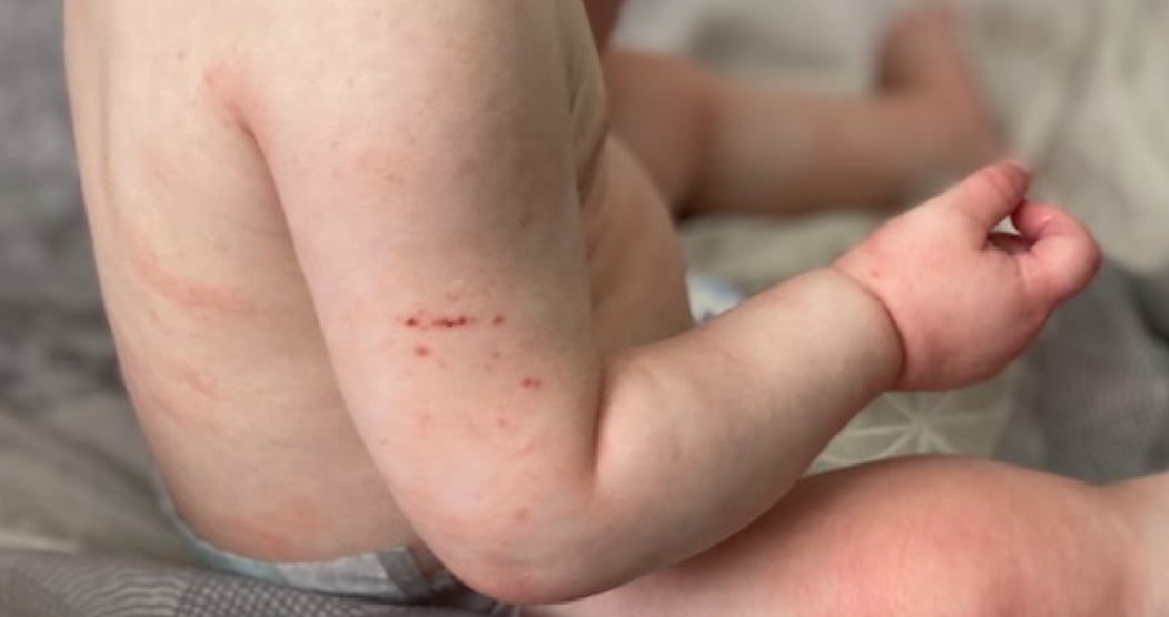 baby with grazes