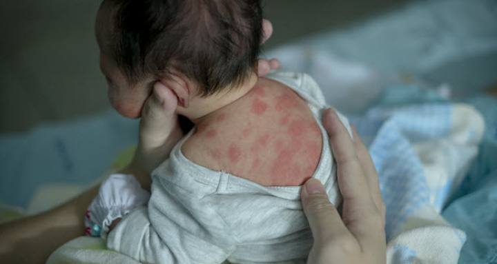 neugeborenes baby mit hautzustand