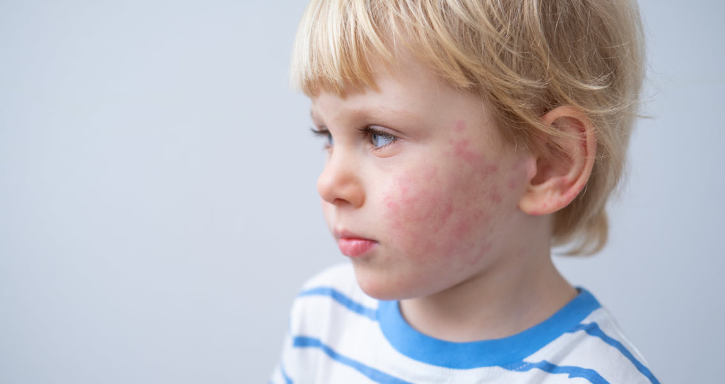 A boy with atopic dermatitis
