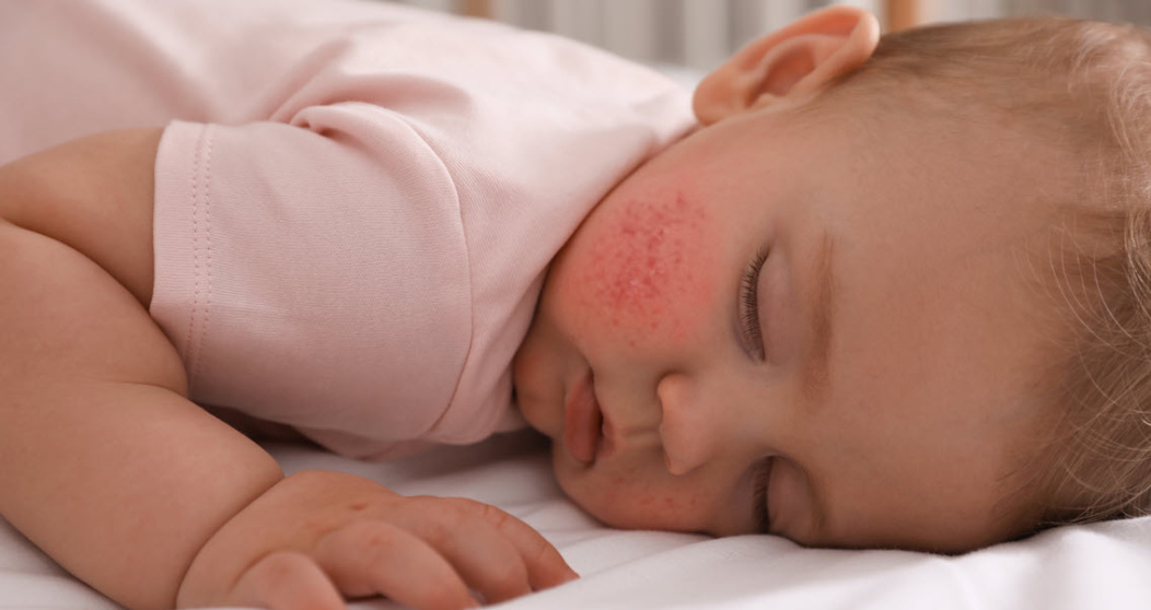 A baby with atopic dermatitis having a nap