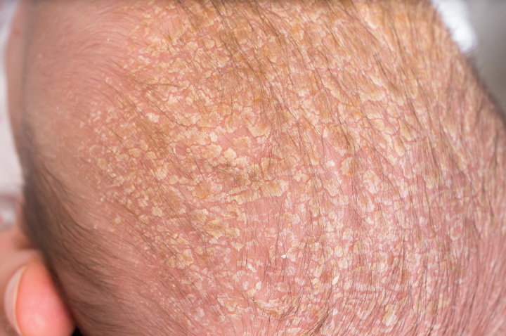 cuero cabelludo del bebé con dermatitis seborreica.