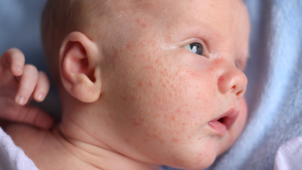 baby with acne