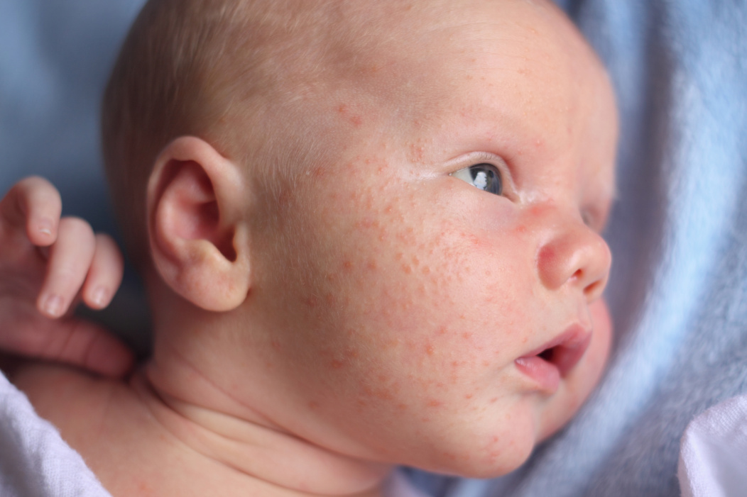 Un bebe con una afeccion cutanea en la cara acostado boca arriba.