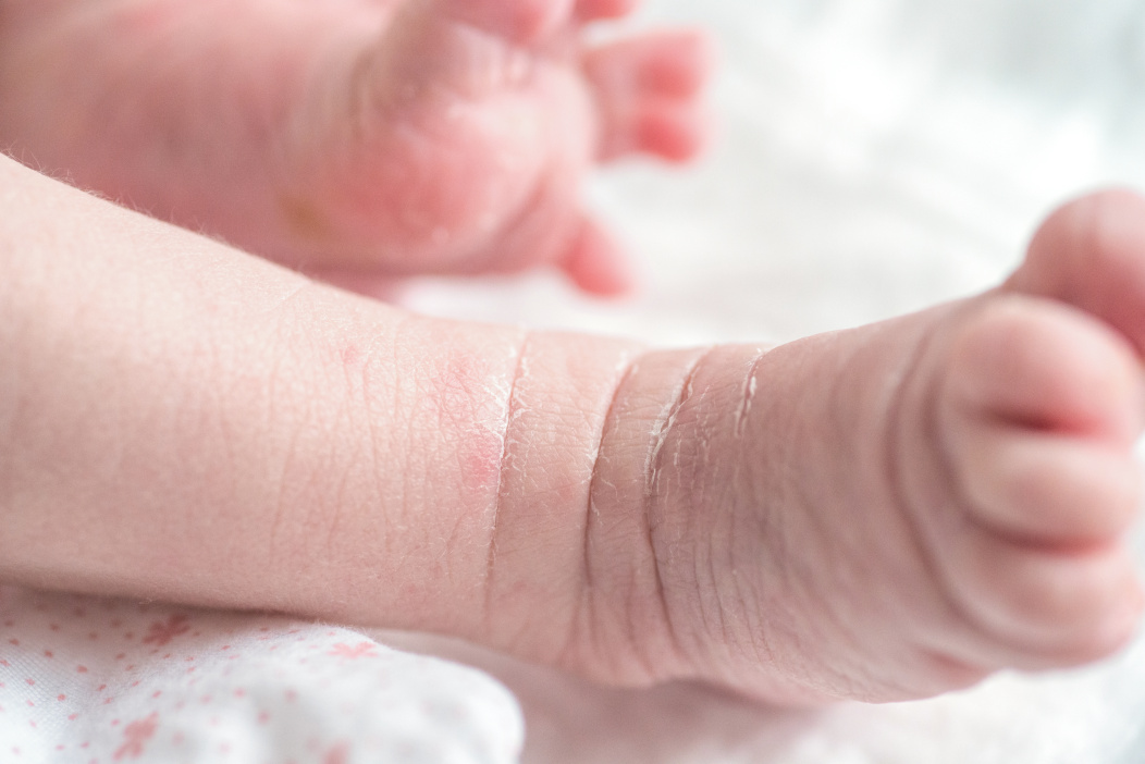 Le pied d'un bébé présentant une affection cutanée.