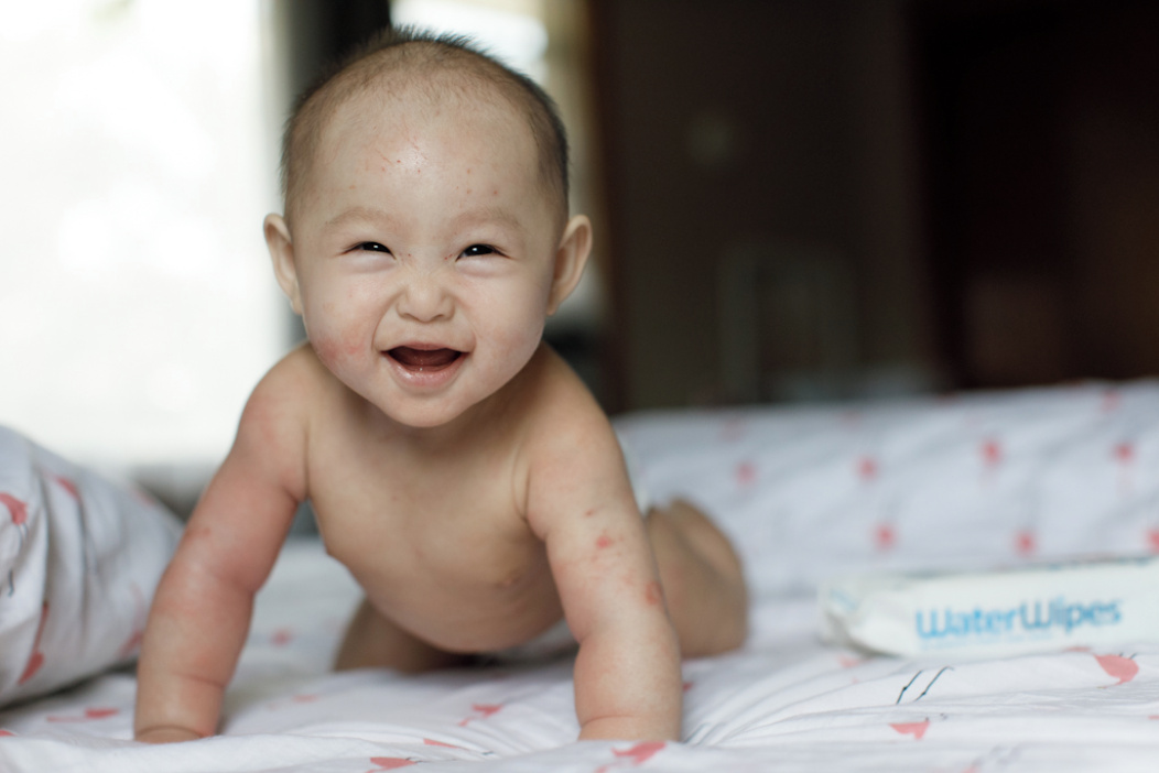 smiling baby with eczema